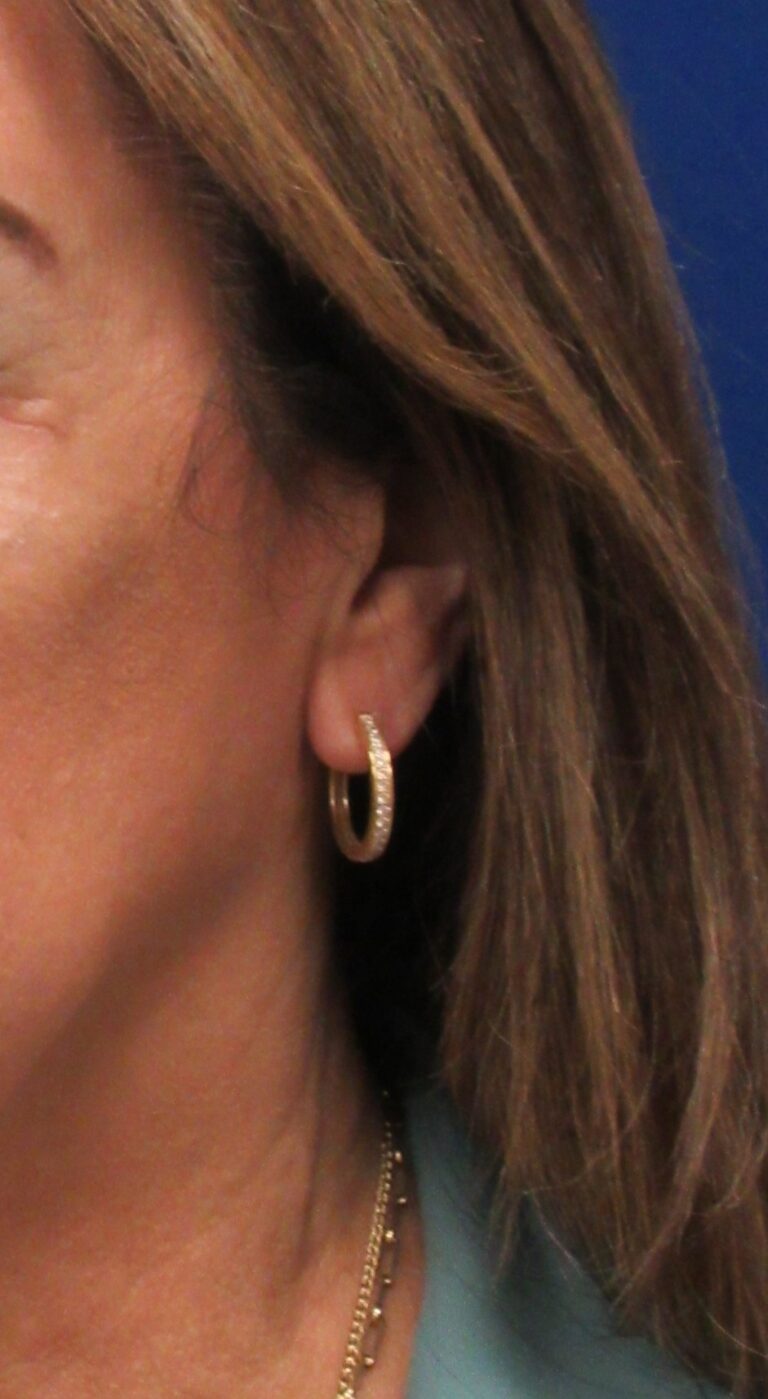 After Image: Earlobe Repair Patient 2 - front