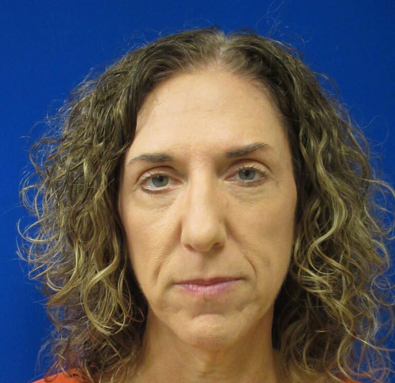 After Image: Blepharoplasty Patient 16 - front