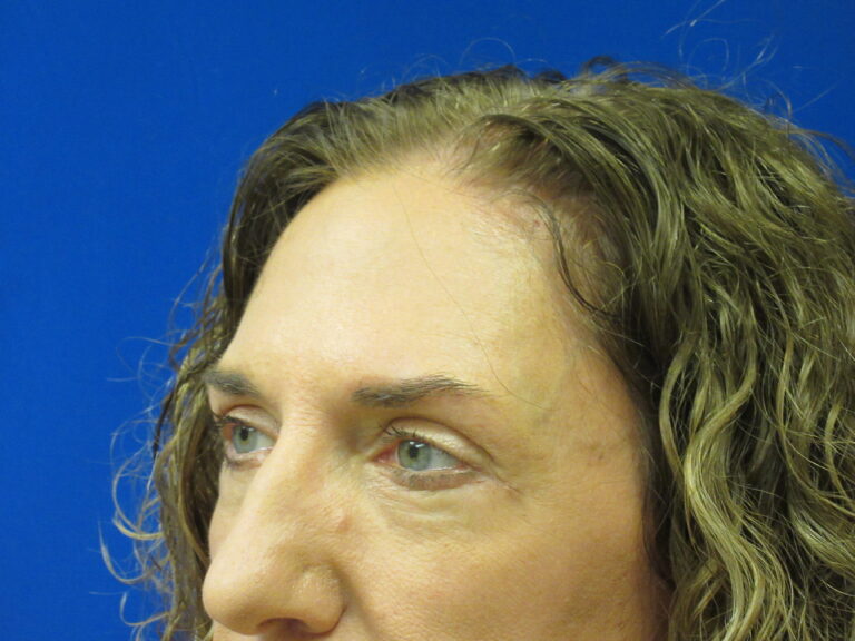 After Image: Blepharoplasty Patient 16 - left-front-oblique