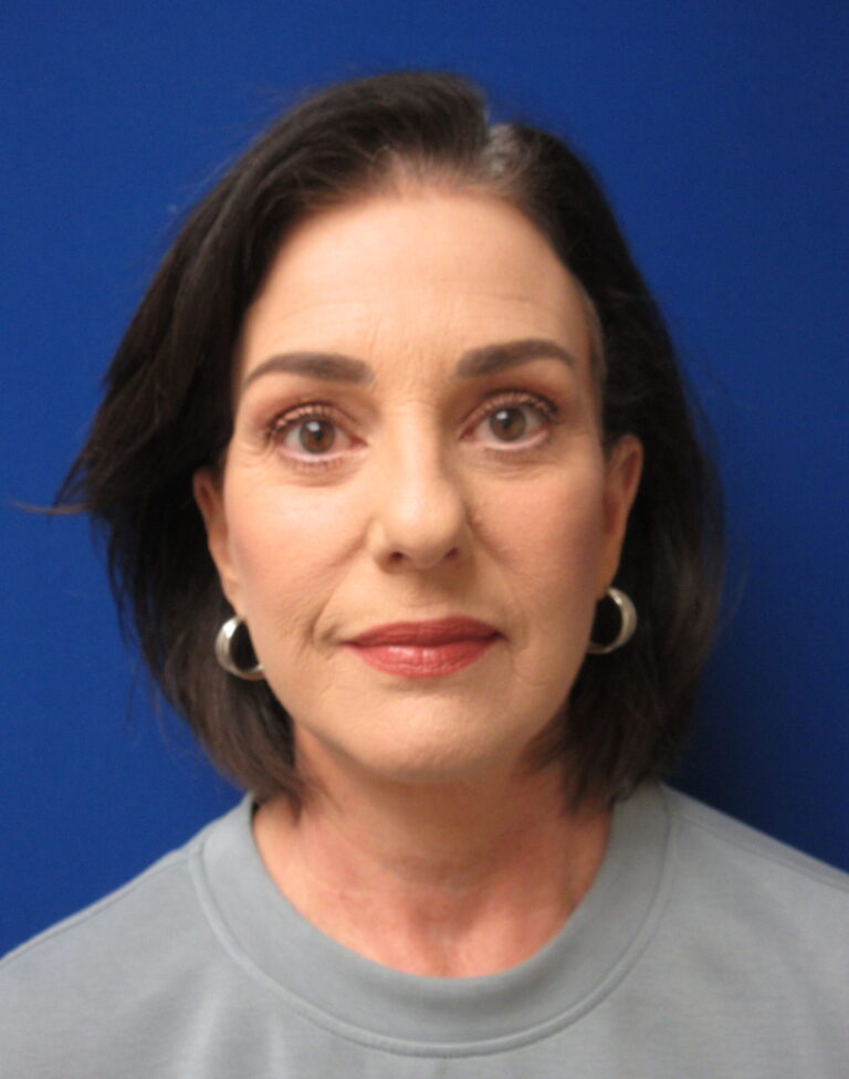 After Image: Facelift Patient 4 - front