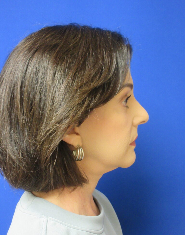 After Image: Facelift Patient 4 - right-side
