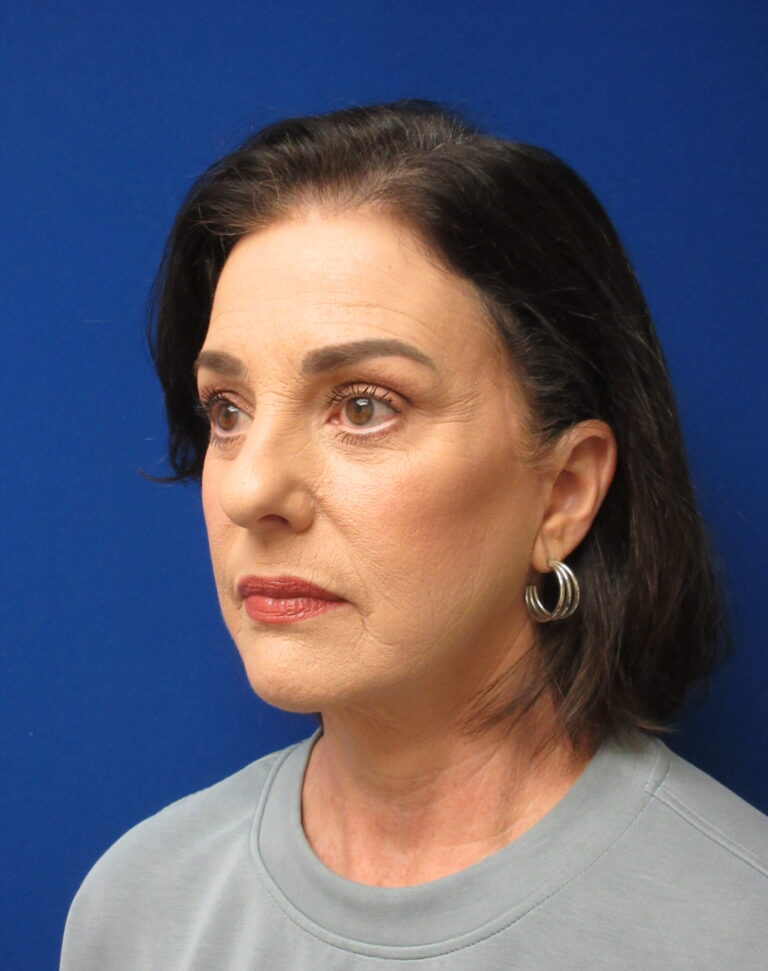 After Image: Facelift Patient 4 - left-front-oblique