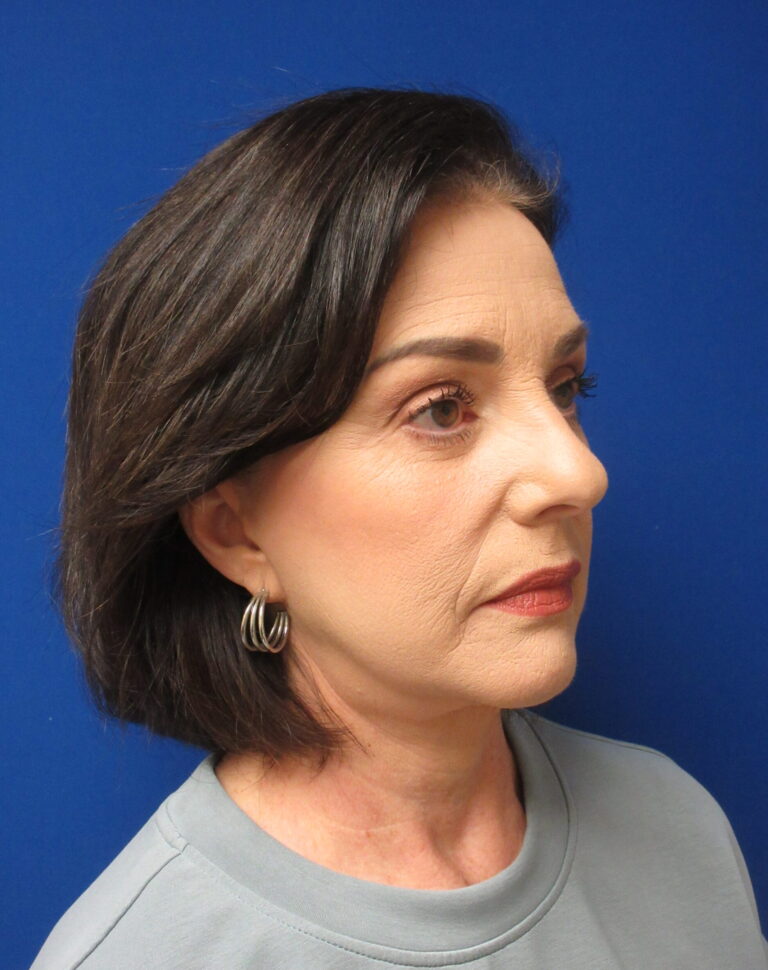 After Image: Facelift Patient 4 - right-front-oblique