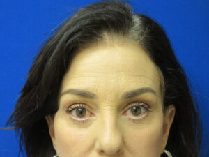After Image: Browlift Patient 6
