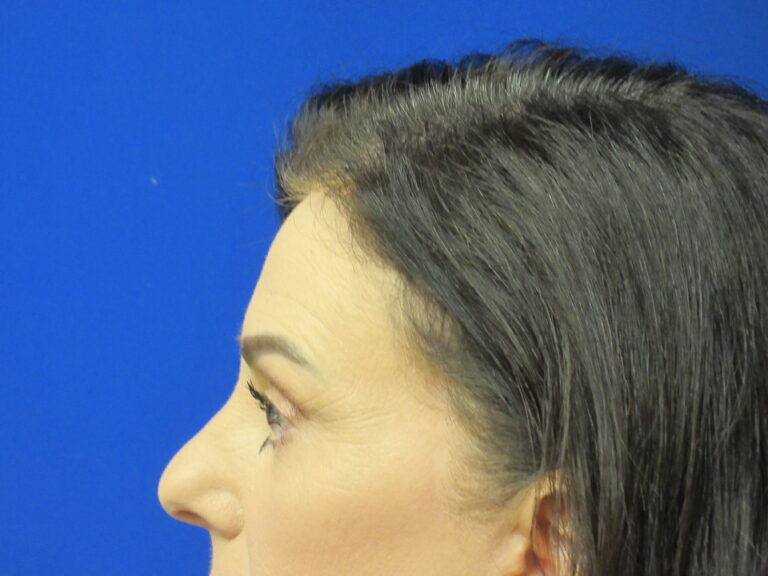 After Image: Browlift Patient 6 - left-side