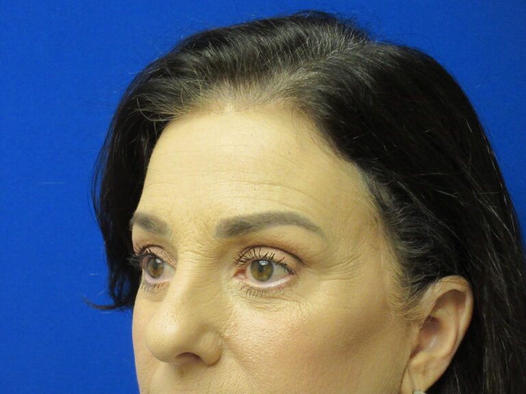 After Image: Browlift Patient 6 - left-front-oblique