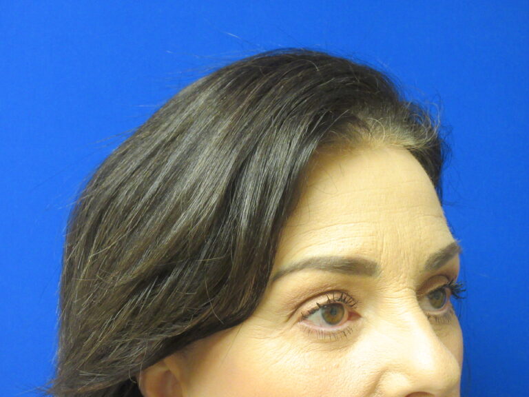 After Image: Browlift Patient 6 - right-front-oblique