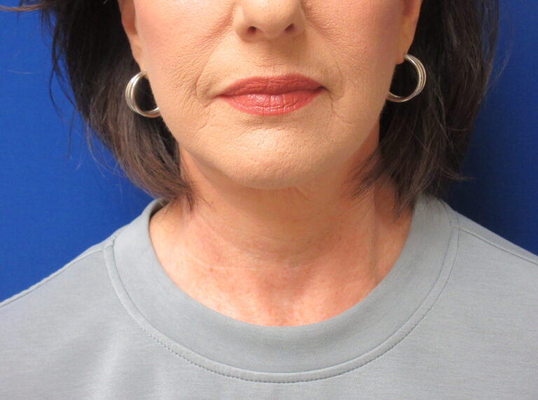 After Image: Neck Lift Patient 7 - front