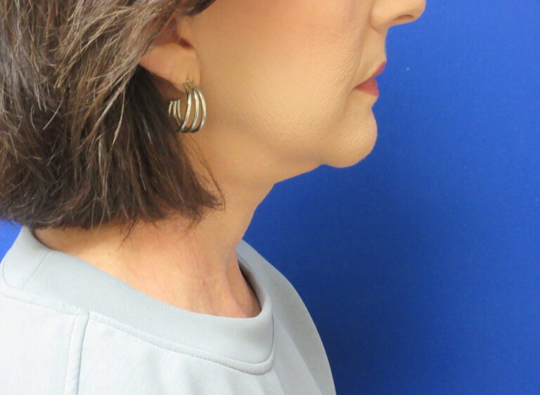 After Image: Neck Lift Patient 7 - right-side