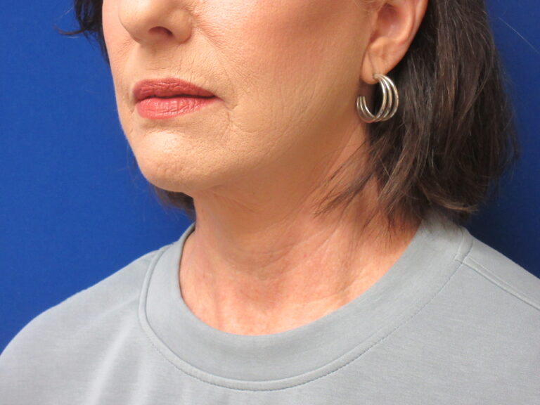 After Image: Neck Lift Patient 7 - left-front-oblique