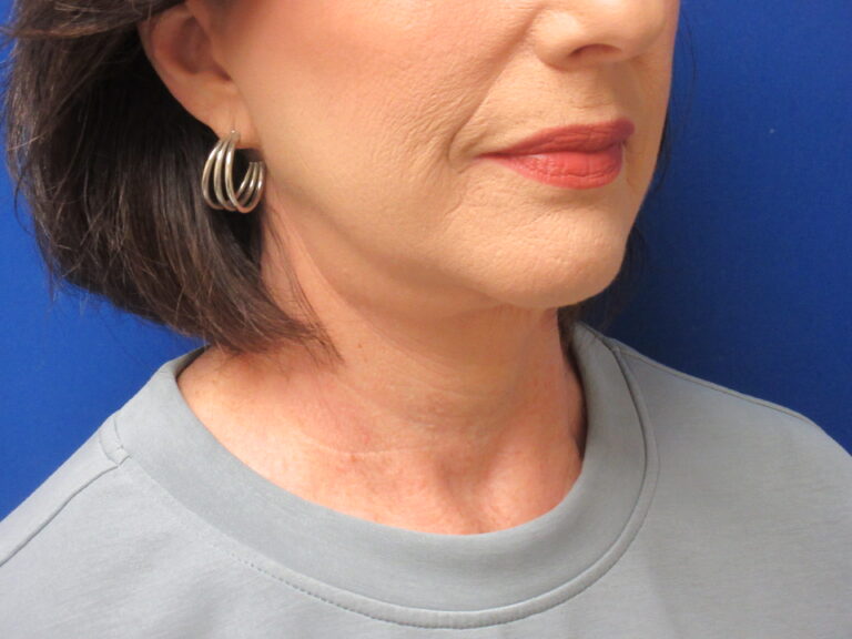 After Image: Neck Lift Patient 7 - right-front-oblique