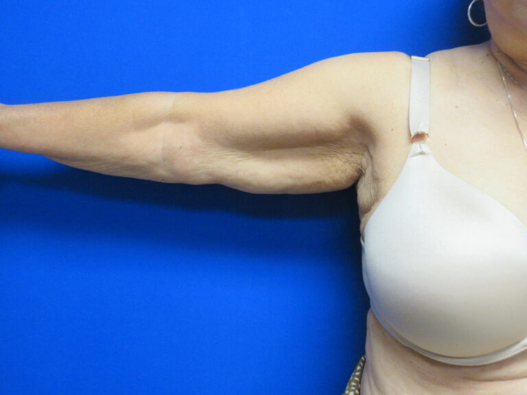 Before Image: Brachioplasty Patient 16 - front