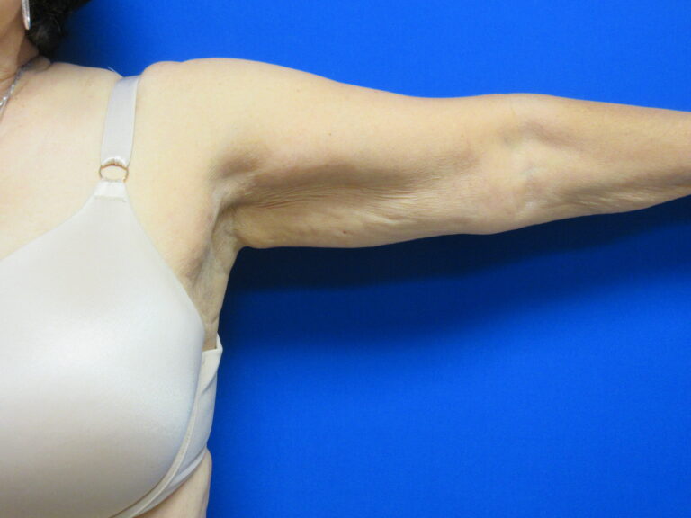 Before Image: Brachioplasty Patient 16 - front