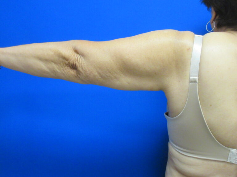 Before Image: Brachioplasty Patient 16 - back
