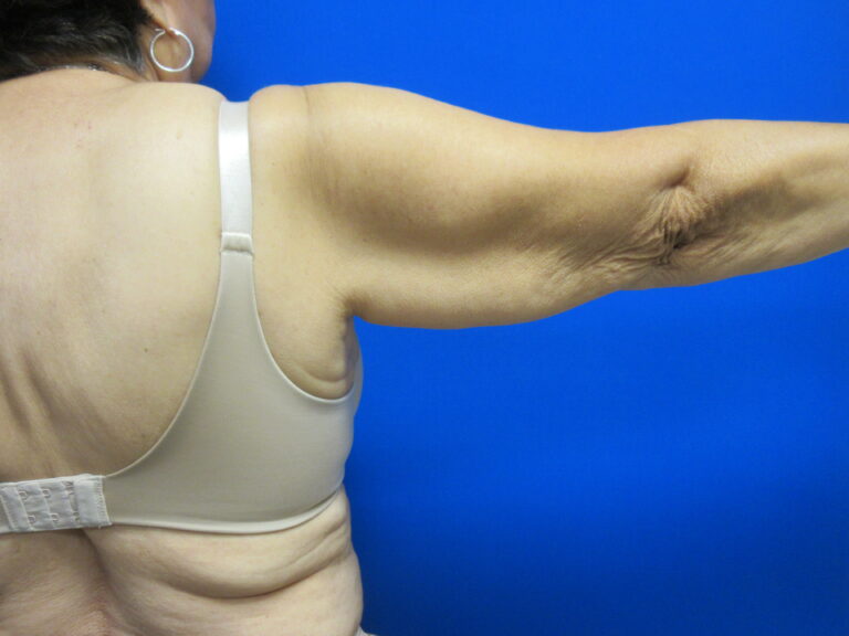Before Image: Brachioplasty Patient 16 - back