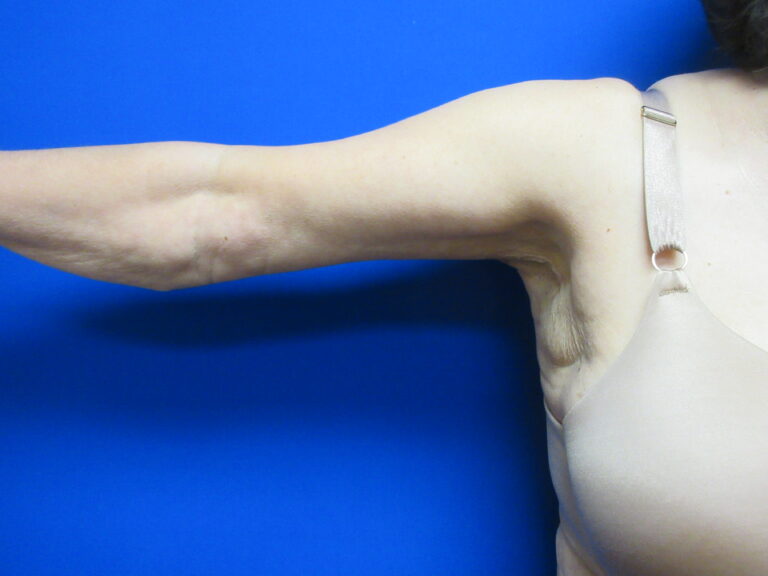 After Image: Brachioplasty Patient 16 - front