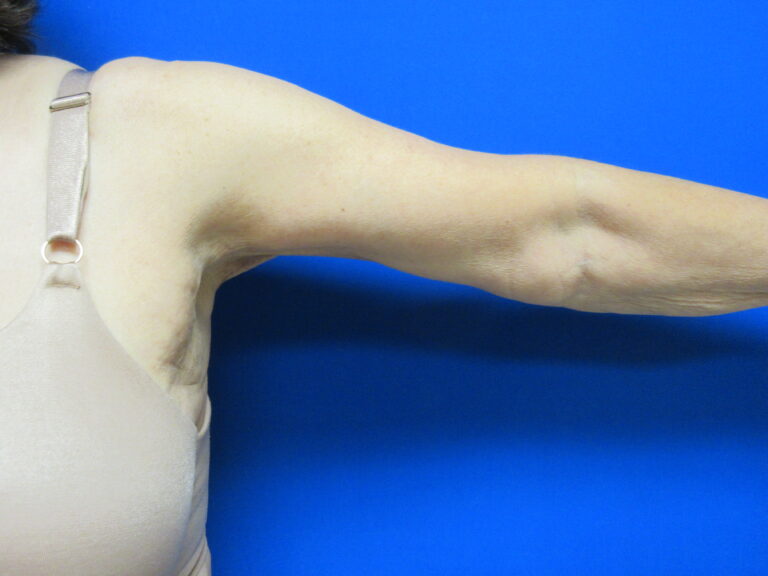 After Image: Brachioplasty Patient 16 - front