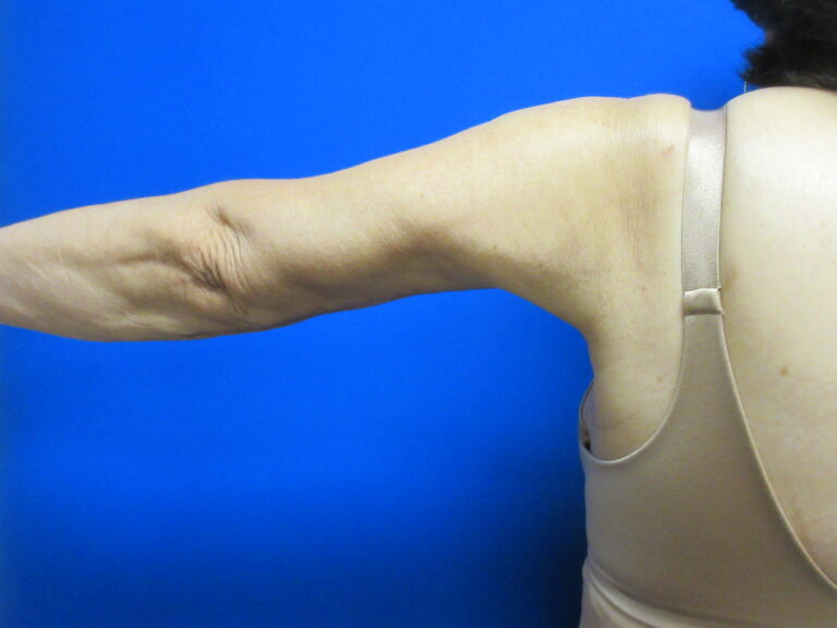 After Image: Brachioplasty Patient 16 - back