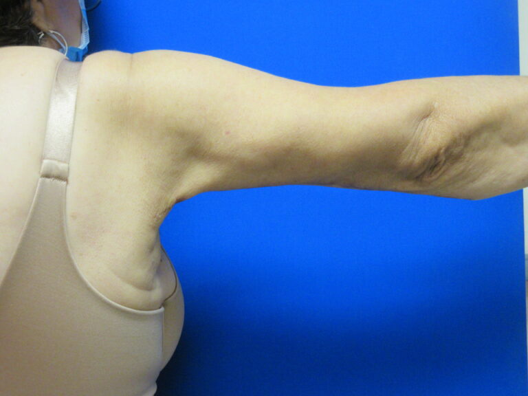 After Image: Brachioplasty Patient 16 - back