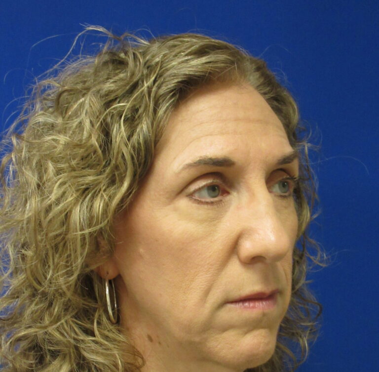 After Image: Blepharoplasty Patient 16 - right-front-oblique