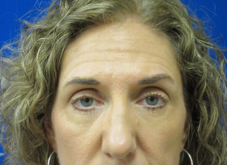 After Image: Blepharoplasty Patient 16 - front