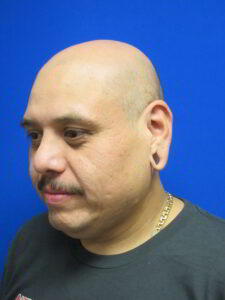 Before Image: Earlobe Gauge Repair Patient 1
