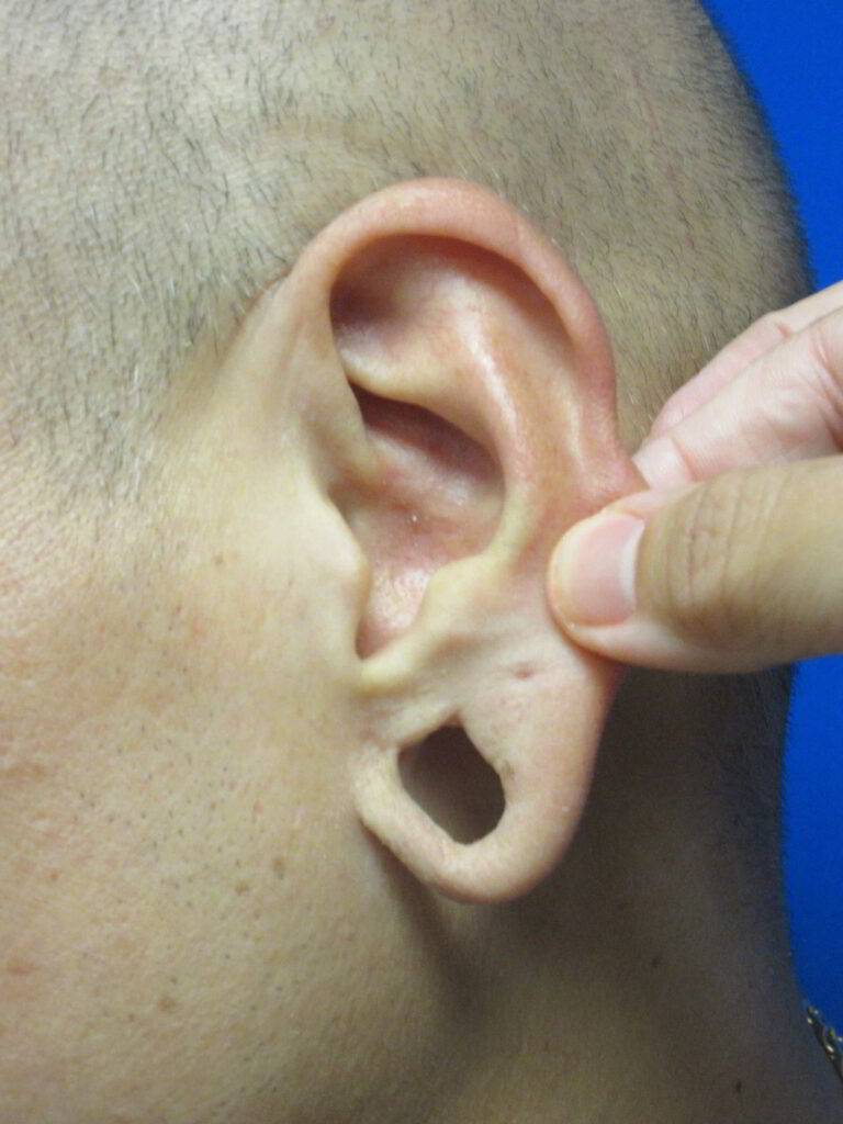 Before Image: Earlobe Gauge Repair Patient 1 - left-front-oblique