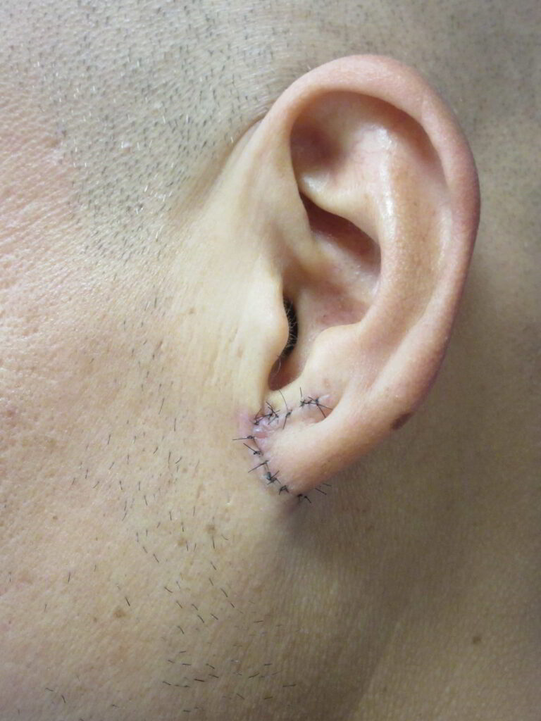 After Image: Earlobe Gauge Repair Patient 1 - left-front-oblique