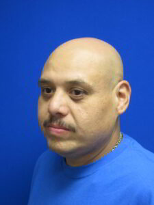 After Image: Earlobe Gauge Repair Patient 1