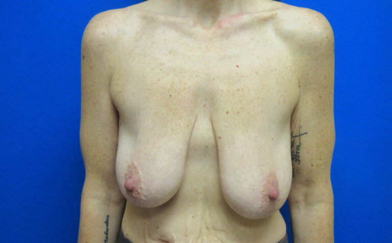 Before Image: Breast Augmentation with Lift Patient 30 - front