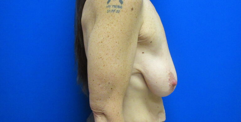 Before Image: Breast Augmentation with Lift Patient 30 - right-side