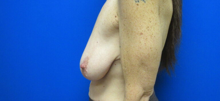Before Image: Breast Augmentation with Lift Patient 30 - left-side
