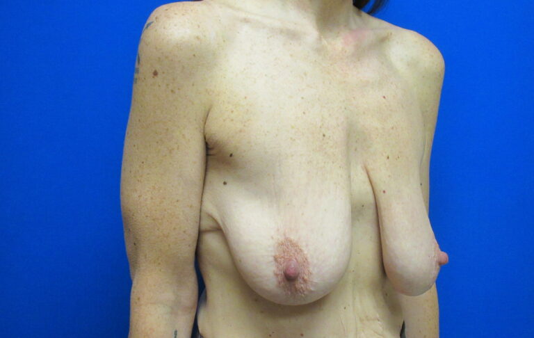 Before Image: Breast Augmentation with Lift Patient 30 - right-front-oblique
