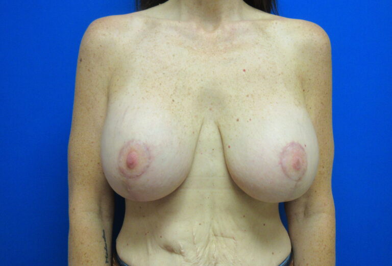 After Image: Breast Augmentation with Lift Patient 30 - front