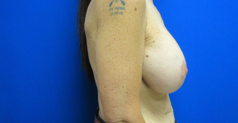 After Image: Breast Augmentation with Lift Patient 30 - right-side