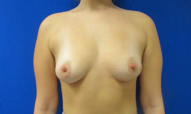 Before Image: Breast Augmentation Patient 173 - front