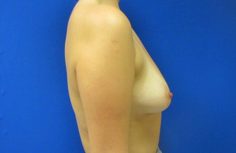 Before Image: Breast Augmentation Patient 173 - right-side