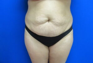 Before Image: Tummy Tuck Patient 64