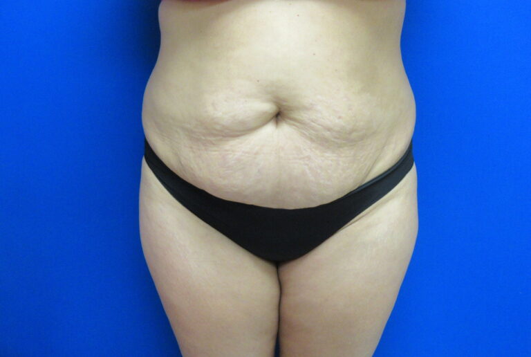 Before Image: Tummy Tuck Patient 64 - front