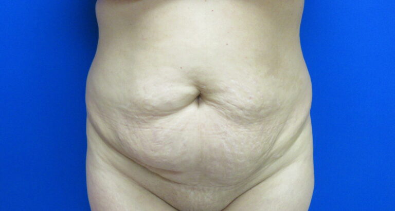 Before Image: Tummy Tuck Patient 64 - front