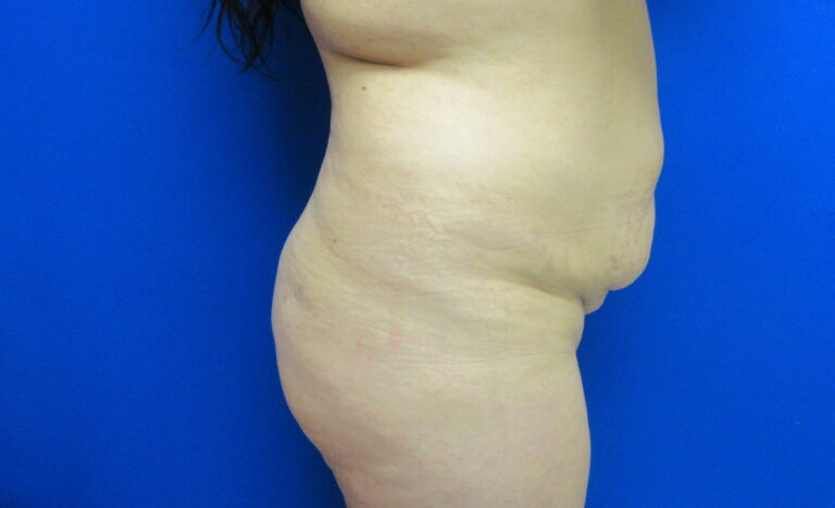 Before Image: Tummy Tuck Patient 64 - right-side