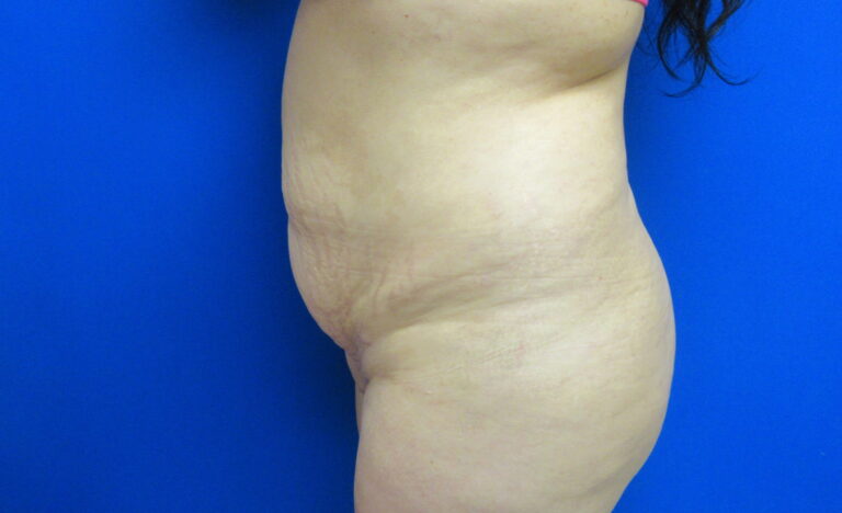 Before Image: Tummy Tuck Patient 64 - left-side