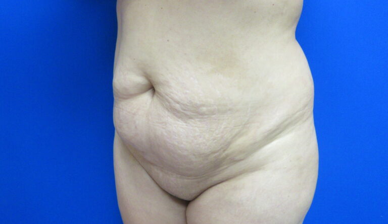 Before Image: Tummy Tuck Patient 64 - left-front-oblique