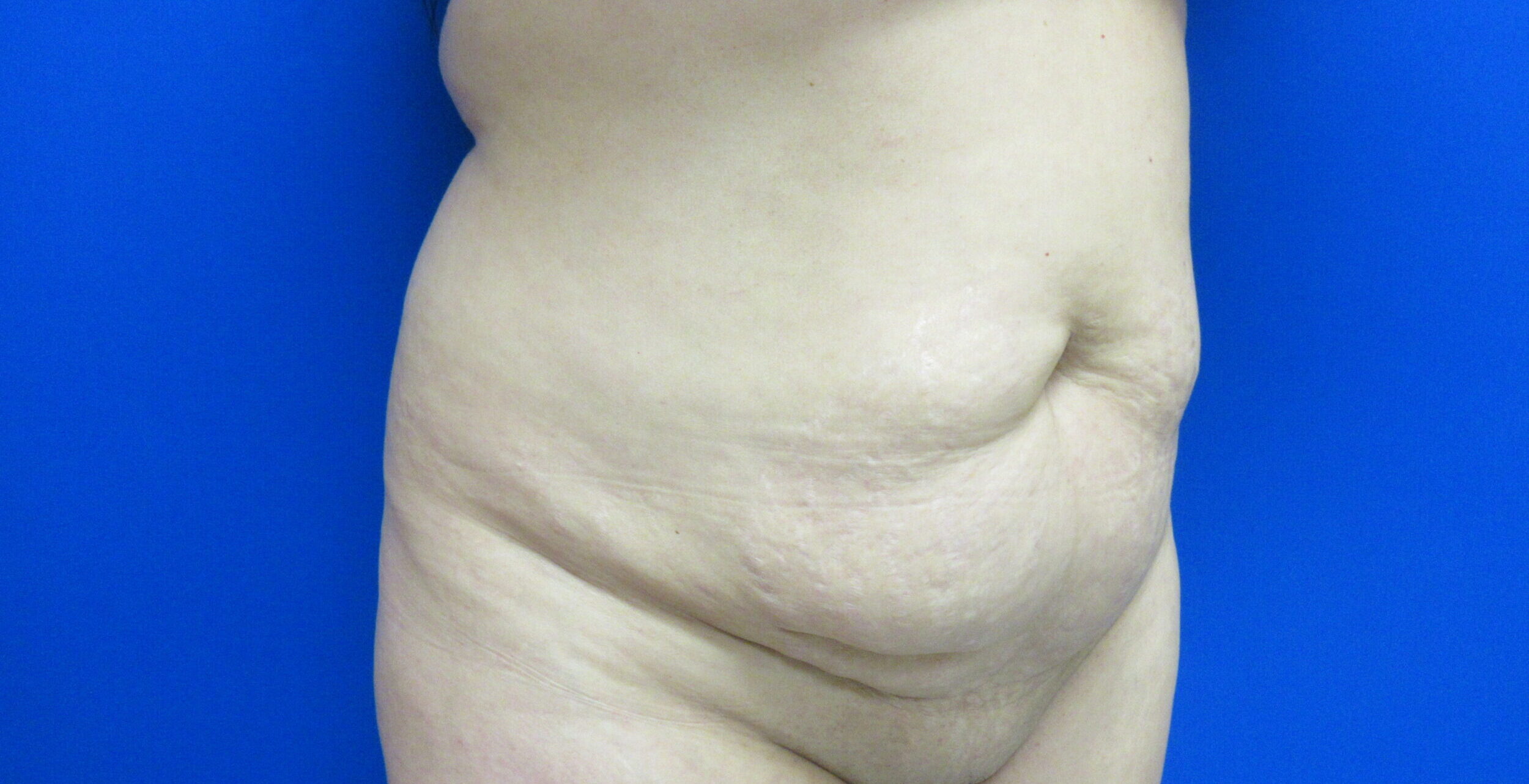 Before Image: Tummy Tuck Patient 64 - right-front-oblique