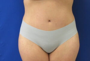 After Image: Tummy Tuck Patient 64