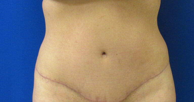 After Image: Tummy Tuck Patient 64 - front