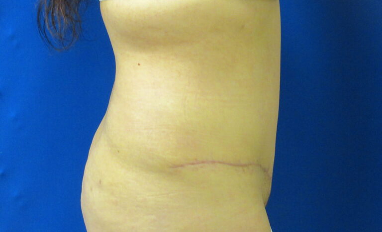 After Image: Tummy Tuck Patient 64 - right-side