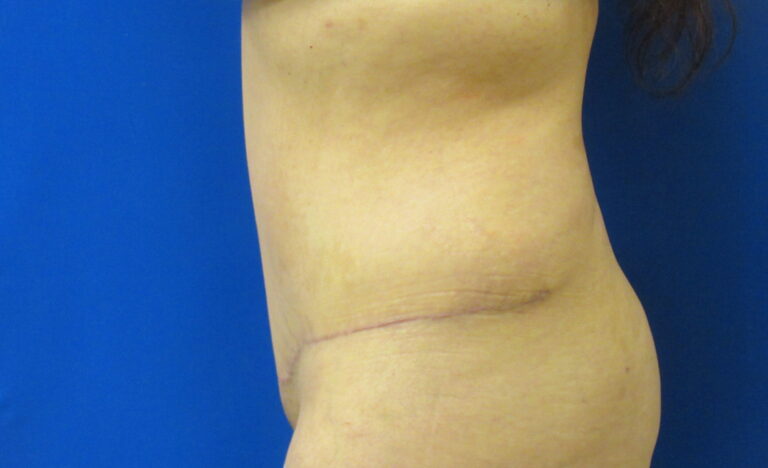 After Image: Tummy Tuck Patient 64 - left-side