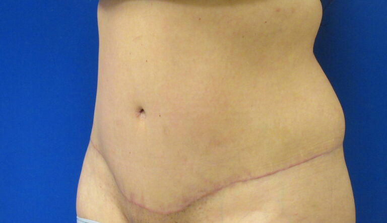 After Image: Tummy Tuck Patient 64 - left-front-oblique