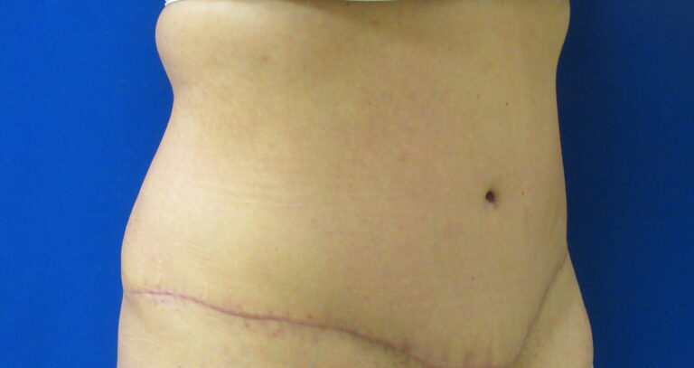 After Image: Tummy Tuck Patient 64 - right-front-oblique